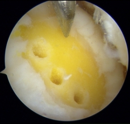 Microfratture di Steadman