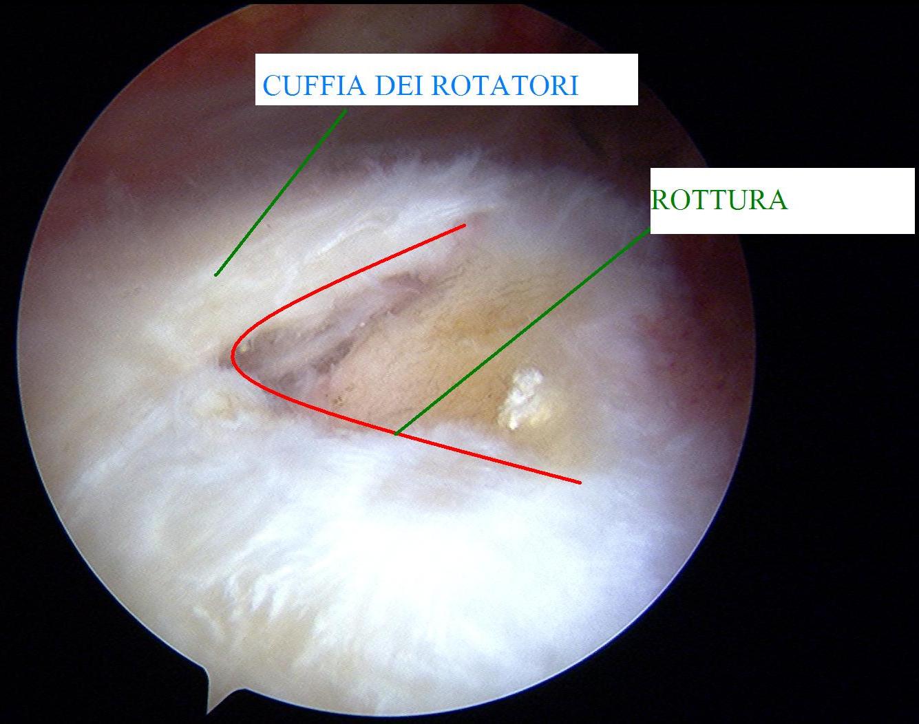 Rottura della cuffia