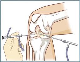 artroscopia di ginocchio